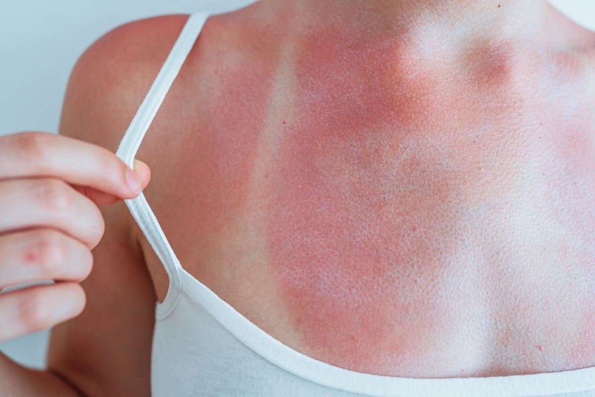 Sonnenbrand in Recklinghausen vermeiden und richtig behandel